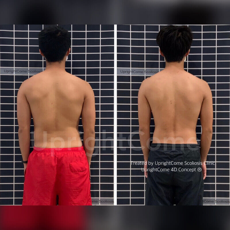 陪你一起戰勝脊椎側彎！