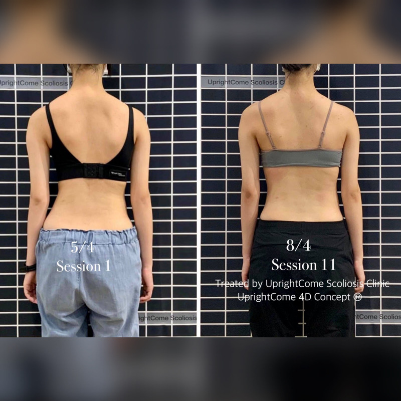 側彎女孩說：「 雖然有些辛苦，但值得了！」