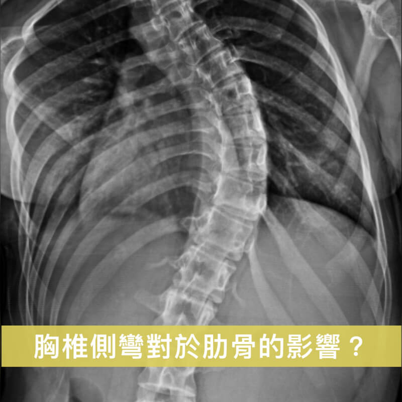 胸椎側彎對於肋骨的影響
