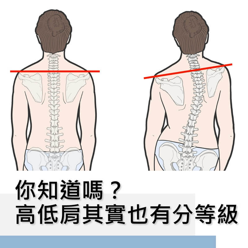 正確判別脊椎側彎造成高低肩狀況