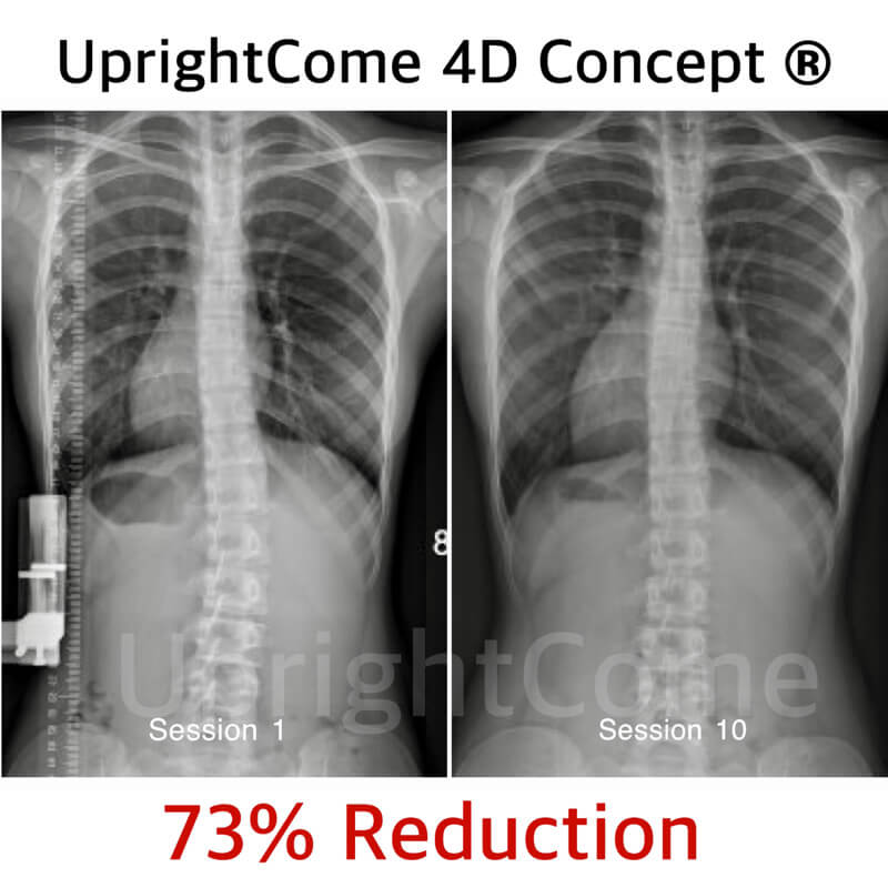 發現脊椎側彎，你會怎麼做？