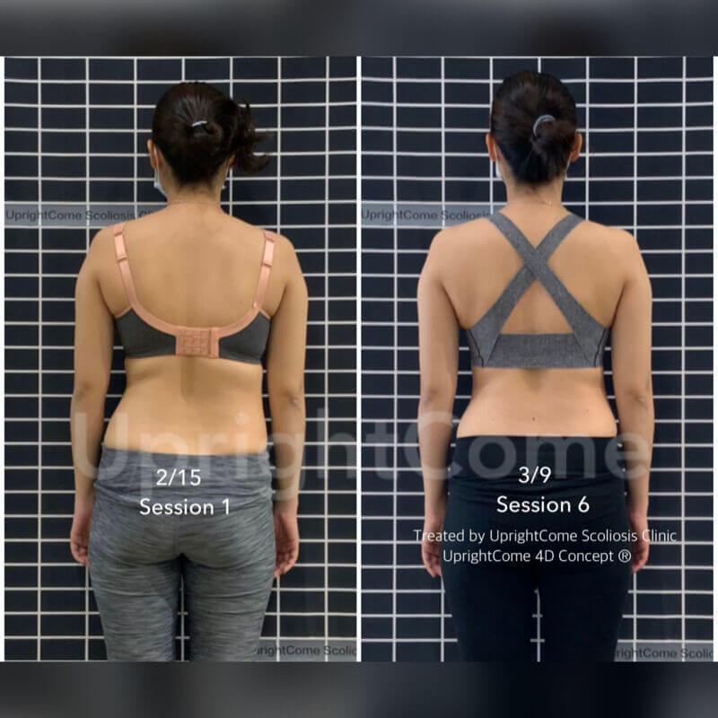 漂亮媽咪的矯正成效