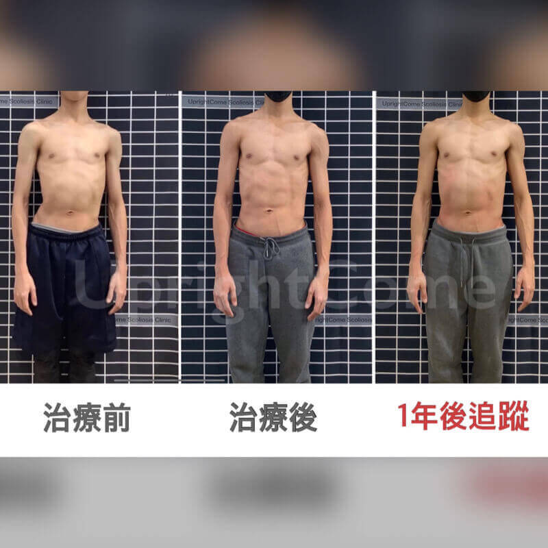 還擔心脊椎側彎矯正後成效沒辦法維持嗎？