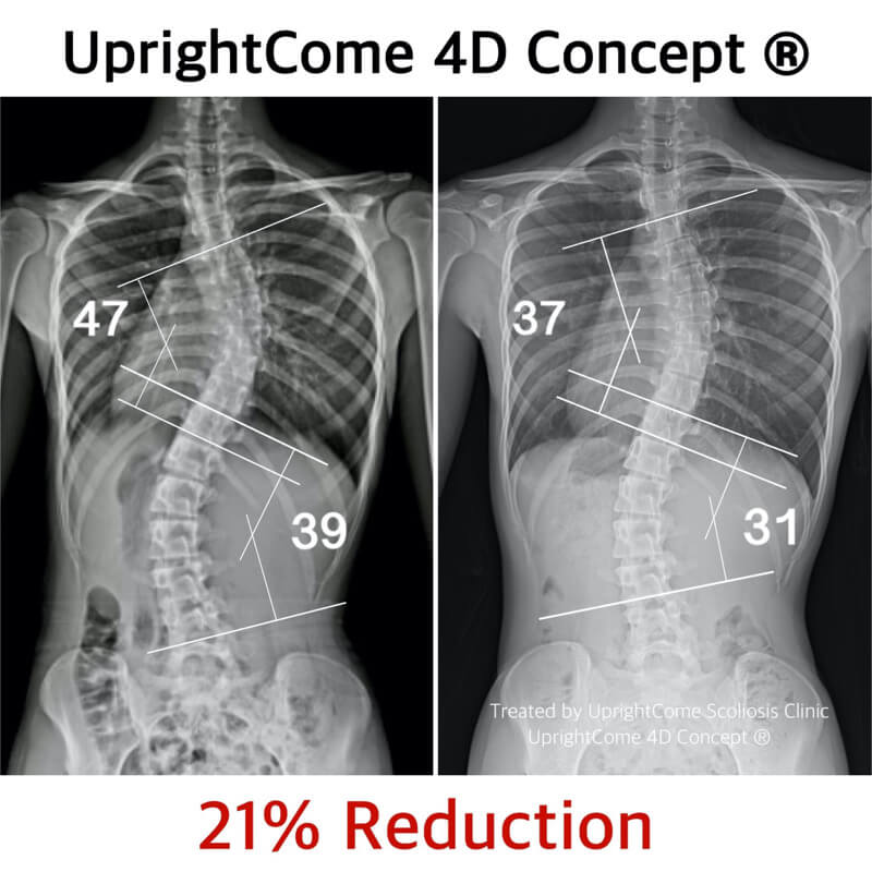 醫生說：「脊椎側彎不用開刀了！」