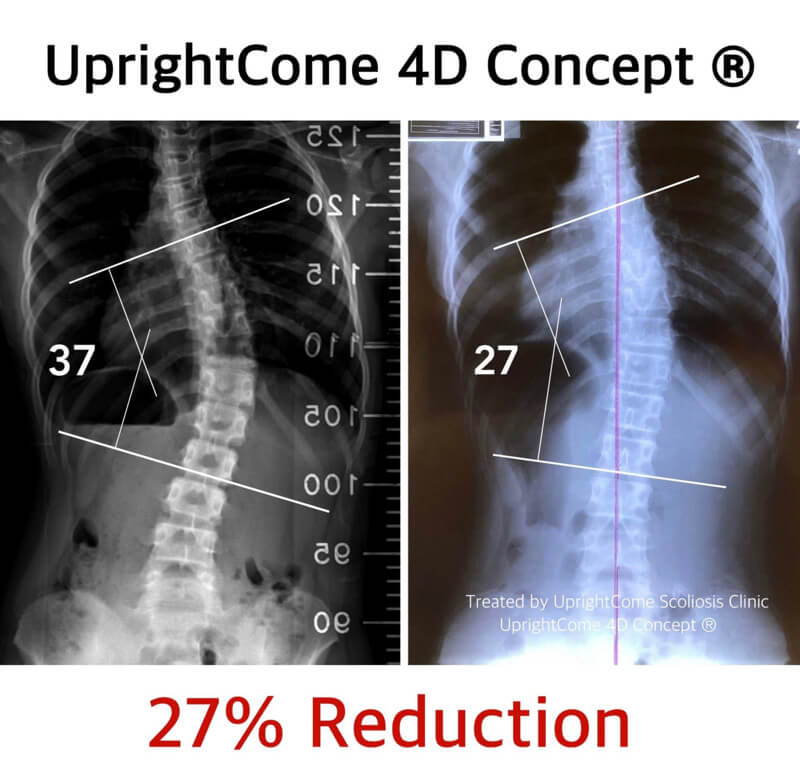 脊椎側彎找對治療方法，讓你事半功倍