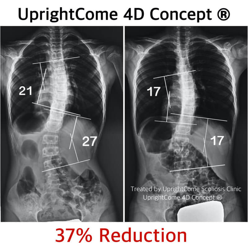 側彎之路想要正正走，給力的神隊友必須有