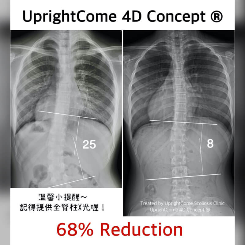 發現脊椎側彎不能只有等待！
