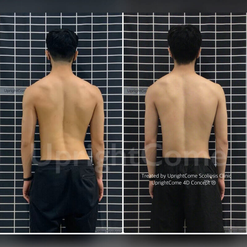 側彎人也有健身不受傷的權利