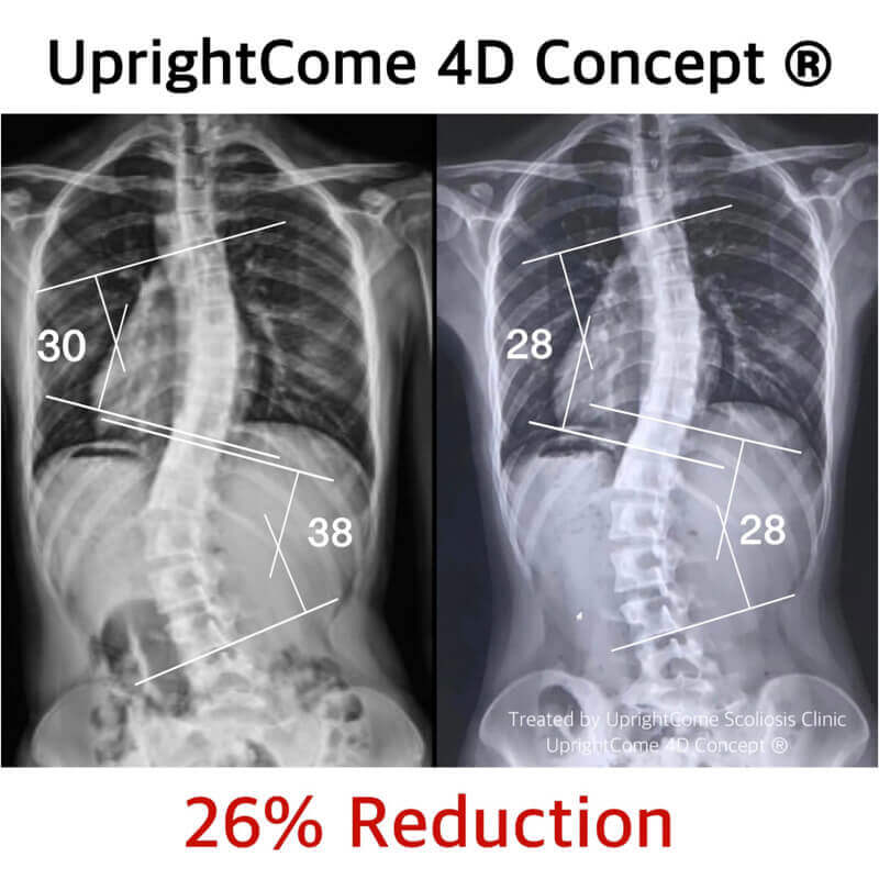 給療程結束持續努力不懈的側彎人