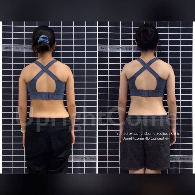 認識脊椎側彎，終結不安