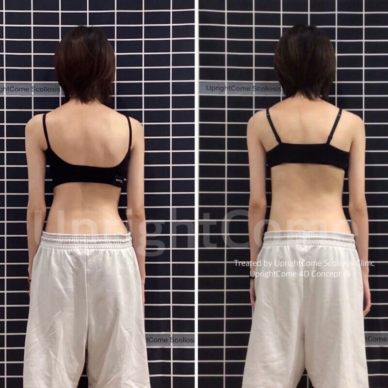 側彎女孩的改變 你看得見！