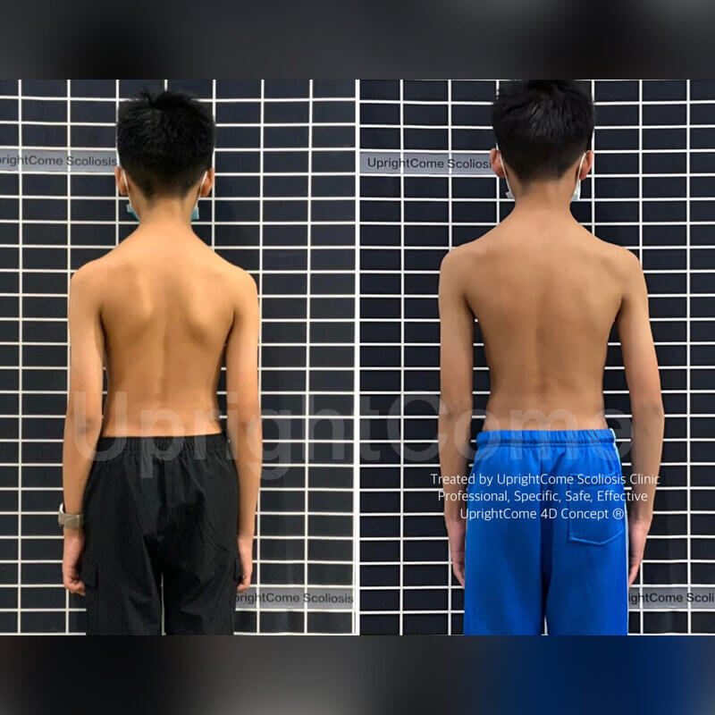 勤奮側彎模範生