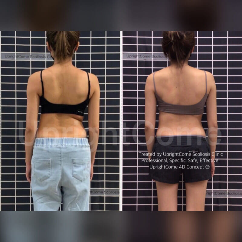 脊椎側彎，從裡到外變得更好
