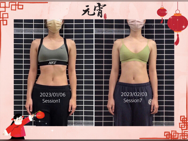 正月開始，脊椎側彎 正正日上