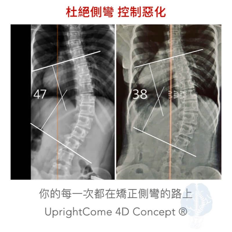 跟脊椎側彎手術說掰掰！