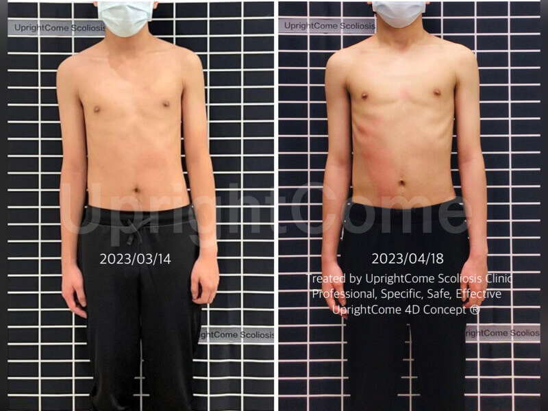 運動對脊椎側彎孩子的影響？