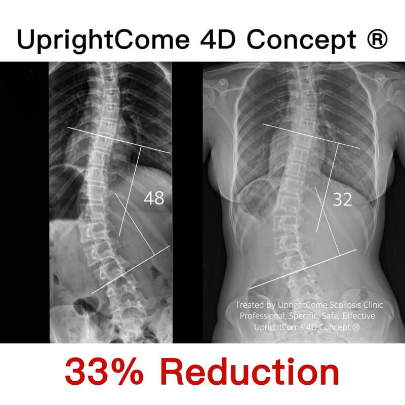 手術並不是重度脊椎側彎人的必經之路
