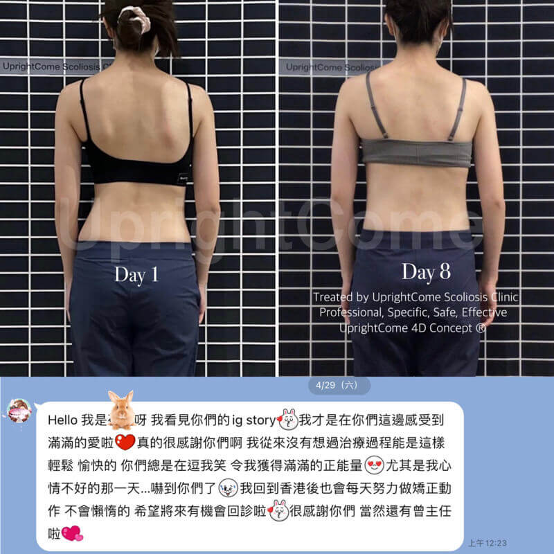 國際脊椎側彎個案， 從香港跨海前來治療