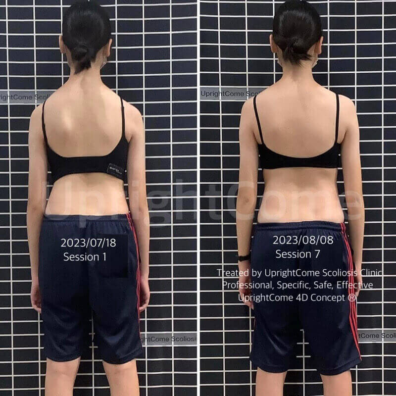 醫師們的選擇，也是脊椎側彎的你最好的選擇