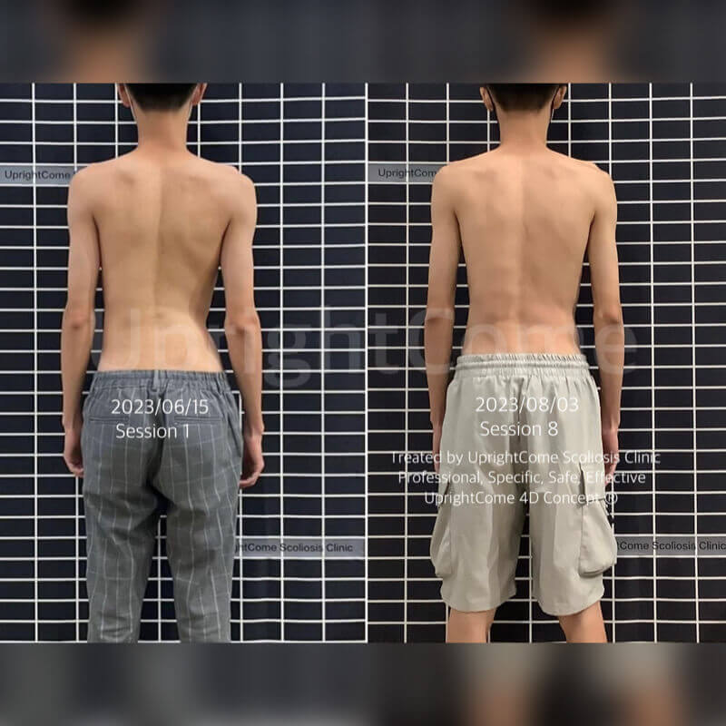 築夢的路上，不讓脊椎側彎成為絆腳石