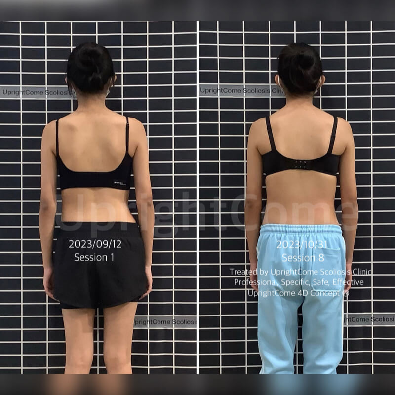 脊椎側彎女孩看見改變中的自己