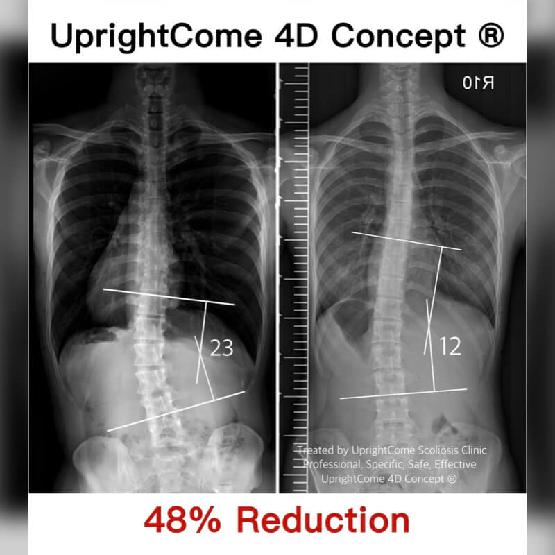 脊椎側彎治療就一定要穿背架嗎？