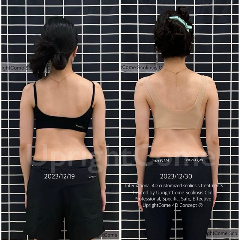 海歸第一件事就是治療脊椎側彎