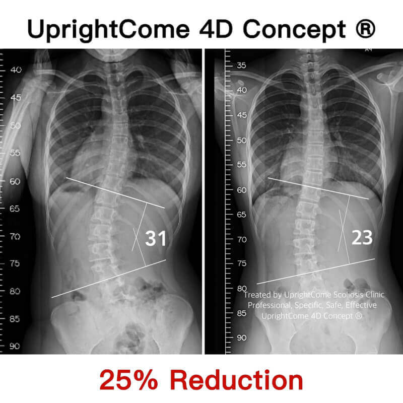13 歲 31 度 S 型脊椎側彎女孩