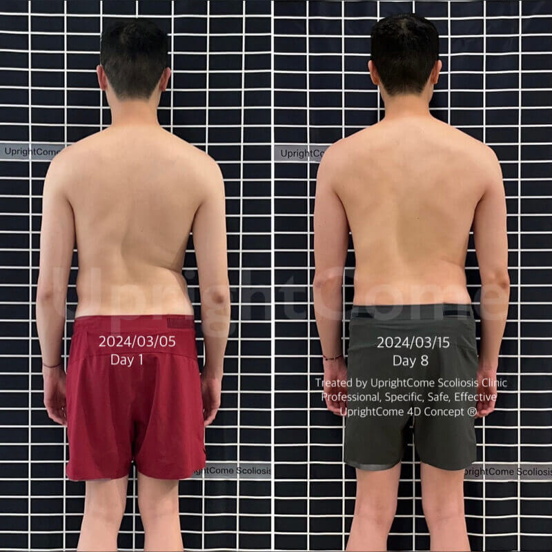 來自香港的重度脊椎側彎男孩