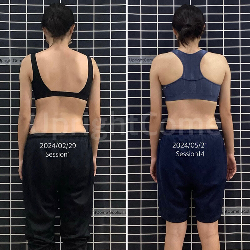 杜絕脊椎側彎持續惡化