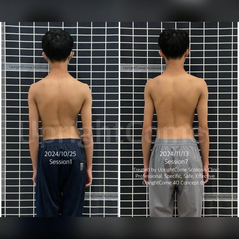 棘手個案：駝背後凸症合併脊椎側彎矯正