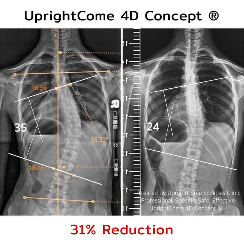 堅持音樂夢想的脊椎側彎女孩