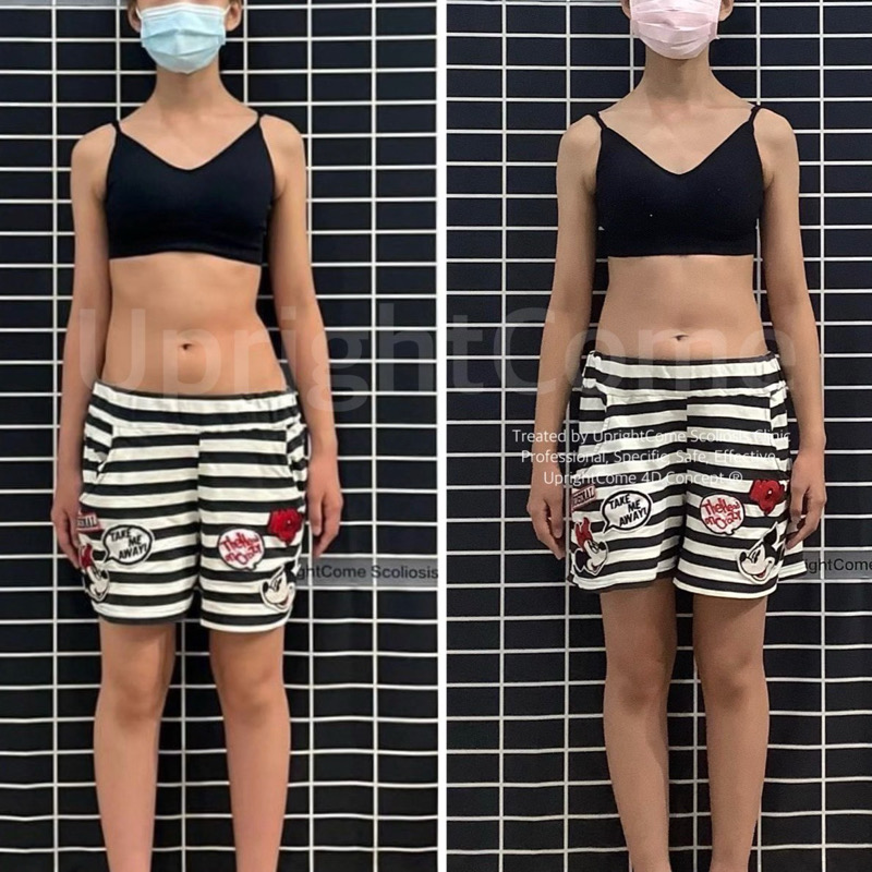 日常診療片刻：脊椎側彎治療中的挑戰與欣慰