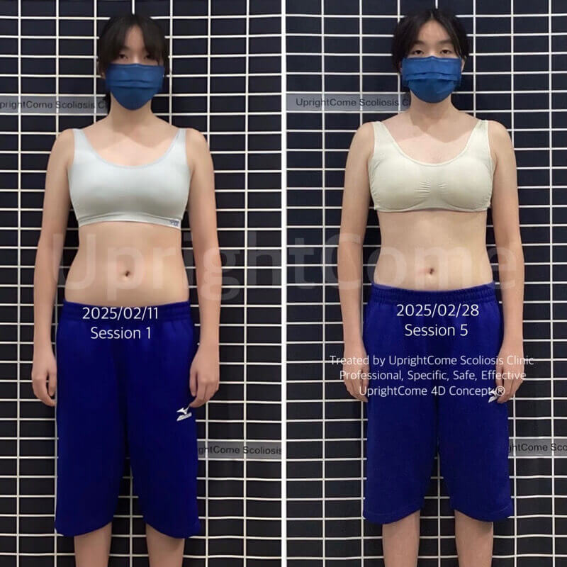 迎戰會考與脊椎側彎：會考女孩的堅毅之路