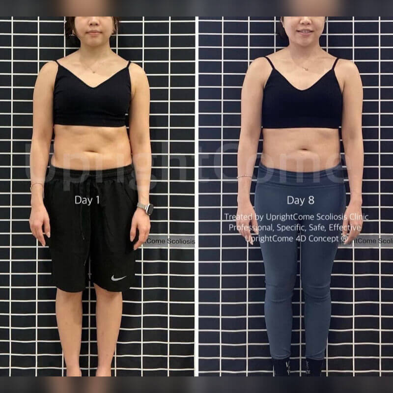 來自澳門的 68 度脊椎側彎女孩，控制成年惡化！