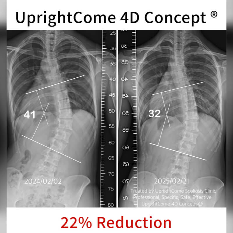 沒想到成年後的我，脊椎側彎還有改變的機會！