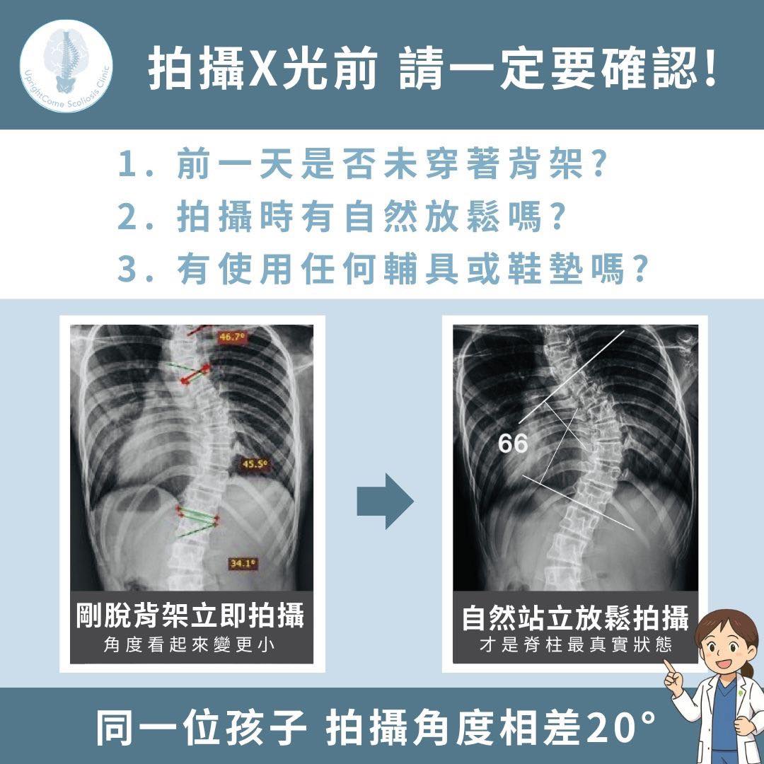 【 脊椎側彎X光拍攝要注意什麼？】 錯誤時機恐導致誤診、假進步（案例解析）