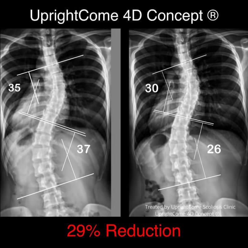 這是一位台北 23 歲,S 型 37 度中重症脊椎側彎女孩,大學畢業的她,在沒有背架介入的情況下,經由挺立康 4D 側彎治療,腰椎脊椎側彎角度改善了 29 % 、身體旋轉指數改善 41 % 、身高也長高了 2.6 公分!!!