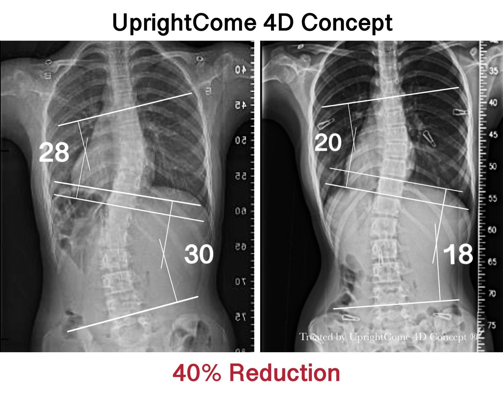 X Ray Uprightcome Scoliosis Clinic Scoliosis Correction Specialist X Ray Uprightcome Scoliosis Clinic Scoliosis Correction Specialist