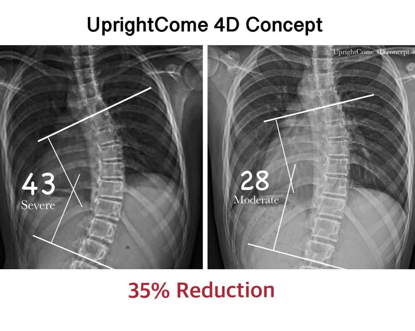 脊椎側彎患者經過側彎矯正治療後，腰椎角度由43度減少到28度，有35%的改善。