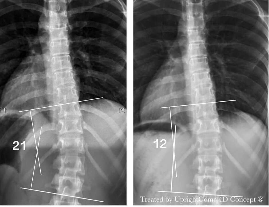 脊椎側彎患者經過側彎矯正治療後，胸椎側彎角度由21度減少到12度。