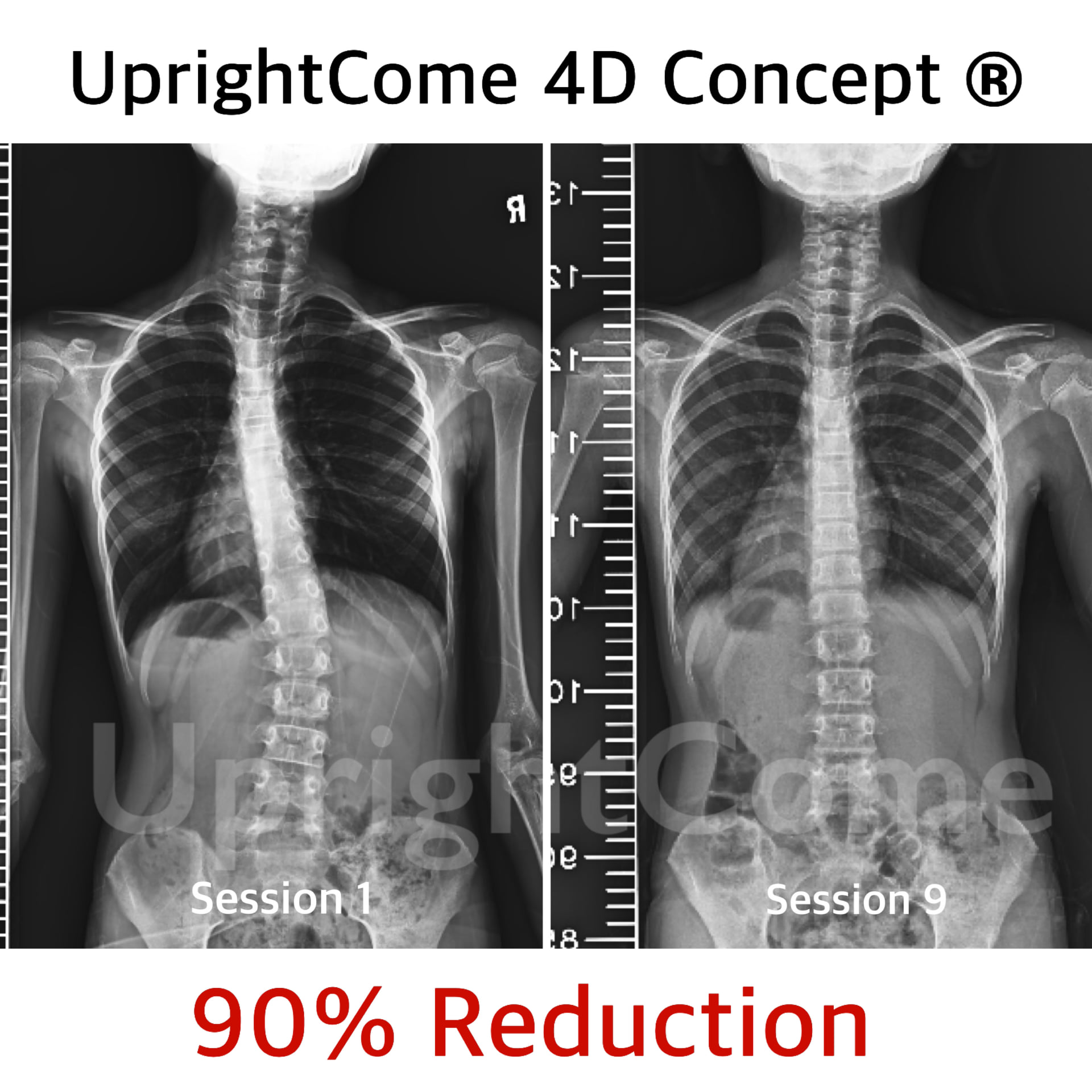 脊椎側彎患者經過側彎矯正治療後，胸椎角度由28度減少到6度，腰椎角度由24度減少到11度。