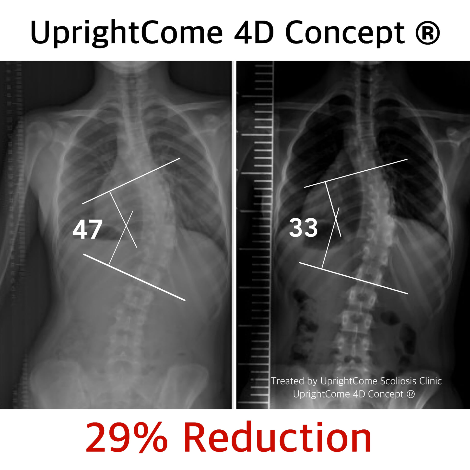 脊椎側彎患者經過側彎矯正治療後，胸椎側彎角度由47度減少到33度。