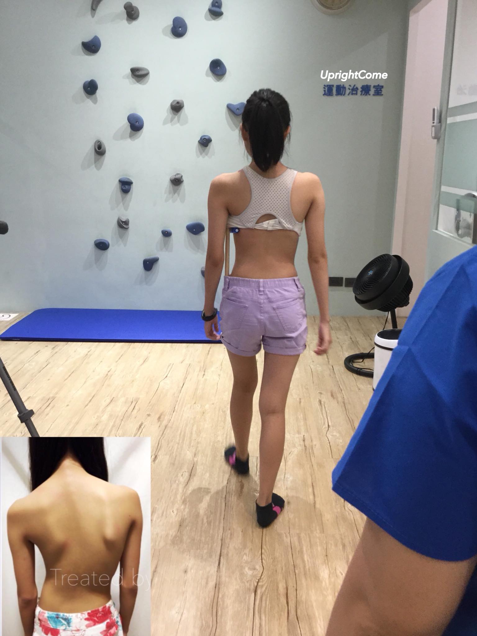 爸爸視角-挺立康脊柱美學物理治療所-青少年原發性脊柱側彎-脊椎側彎