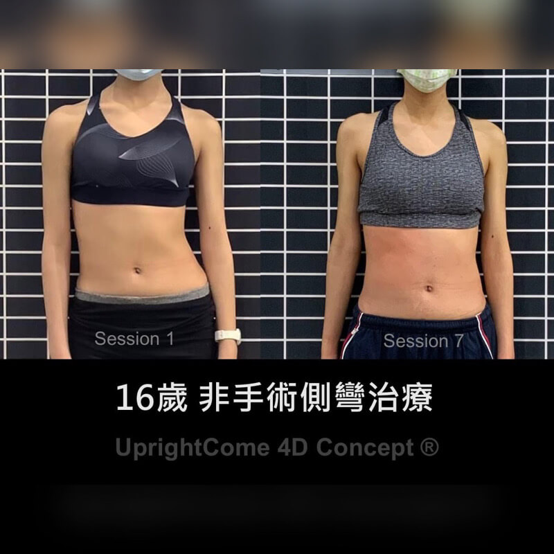 當超神側彎治療團隊遇上自律女孩，雙重的努力、加倍的用心，給你煥然一新的自己。這位 16 歲女孩，在經過 7 次 4D 專屬治療後，體態上的變化讓小編驚呼：太扯啦。其實大家都知道 ，要落實每天做脊椎側彎矯正並不容易，不僅要自律，還要足夠堅定！而這位女孩還會特別增加時間及次數，讓團隊感到非常欣慰，挺立康會一直陪著妳走向「正」的道路。