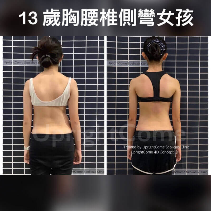 這是一位 13 歲胸腰椎中度脊椎側彎女孩,目前療程來到了尾聲,旋轉角度逐漸減少,身高也長高了 2.5 公分!