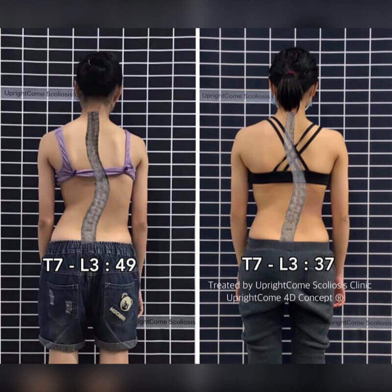 這是一位來自台中 16 歲胸腰重度脊椎側彎女孩,來挺立康之後的她很積極做矯正,在寒假特訓營結束後,有了更多的改變,從 X 光影像上,側彎角度從 49 度改善至 37 度,從原本的重度脊椎側彎改善為不需手術的側彎角度,而從體態上也讓腰線變得更對稱。