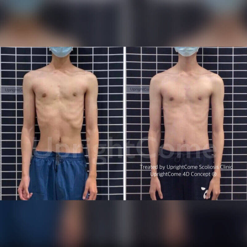 這是一位來自台南 23 歲 S 型脊椎側彎男孩,經過挺立康 4D 初階療程 後。腰線變得更對稱,骨盆、肋骨的狀況也得到改善!