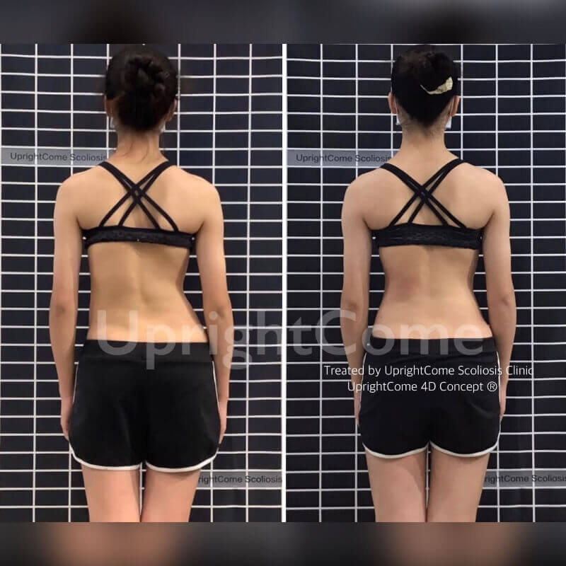 這是一位 16 歲 腰椎重度脊椎側彎女孩,經過挺立康 4D 進階療程後,身高從 166.8 公分變到 169.2 公分,長高 2.4 公分,腰椎的旋轉指數從 13 降至 5 。女孩說:「來到挺立康之後,覺得體態變得越來越對稱了!」