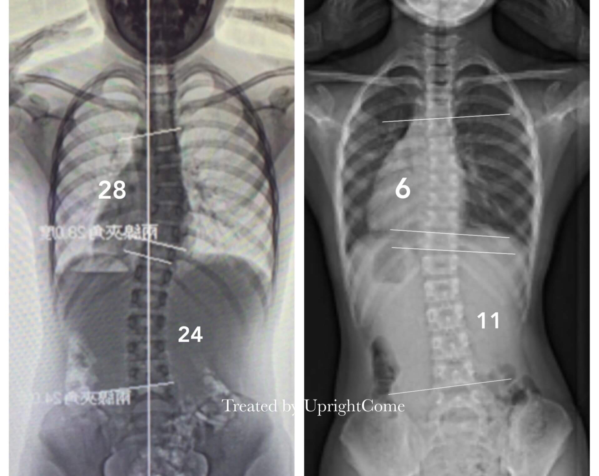 脊椎側彎患者經過側彎矯正治療後，胸椎角度由28度減少到6度，腰椎角度由24度減少到11度。